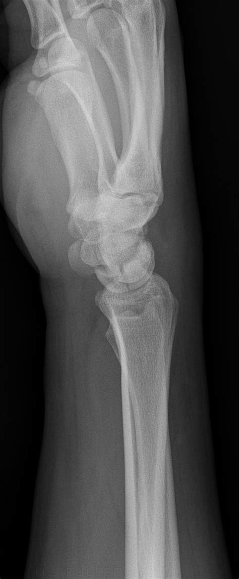 Lunate Fractures WikiRadiography
