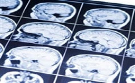 Study Suggests New Treatment Strategy For Deadly Brain Cancer Cn1699