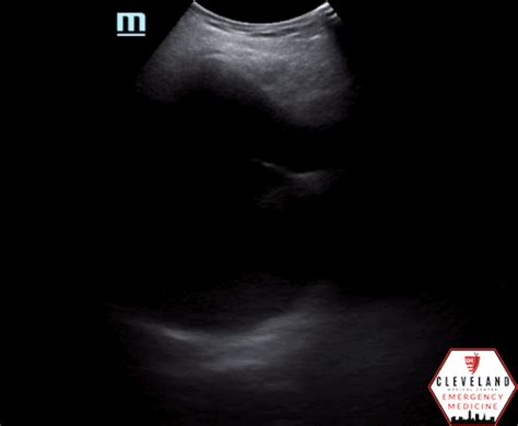 Case Presentation Of Imperforate Hymen And The Utilization Of Pelvic Pocus In The Emergency