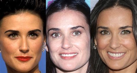 Demi Moore Plastic Surgery Before And After Bad Plastic Surgery