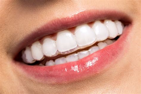 Everything You Need To Know Before Getting Invisible Braces My