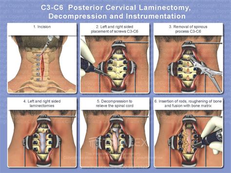 C C Posterior Cervical Laminectomy Decompression And Instrumen