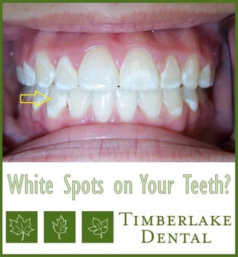 White Spots On Your Teeth Heres What You Need To Know Stronger