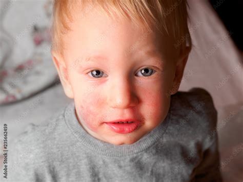 Little Child With Diathesis Symptoms On Cheeks Closeup Surprised