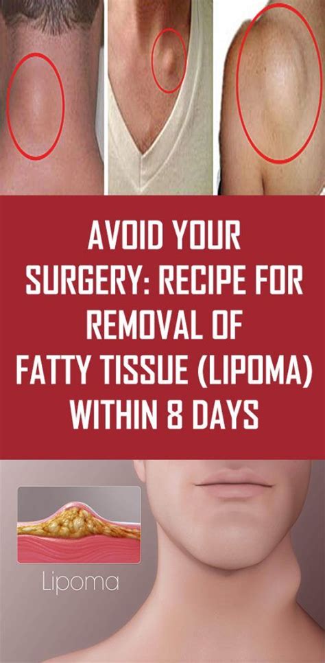 Avoid Your Surgery Recipe For Removal Of Fatty Tissue Lipoma