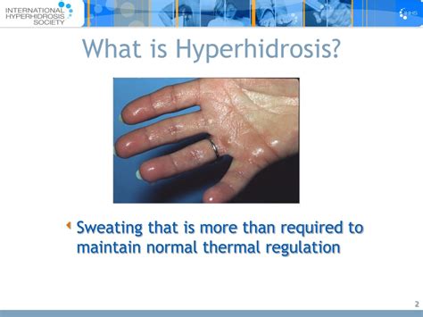Ppt Hyperhidrosis Powerpoint Presentation Free Download Id140832