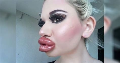 A ‘real Life Barbie Goes Overboard With 20 Lip Filler Injections