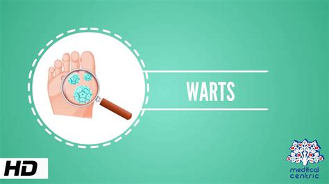 Wart Causes Signs And Symptoms Causes Diagnosis And Treatment Youtube