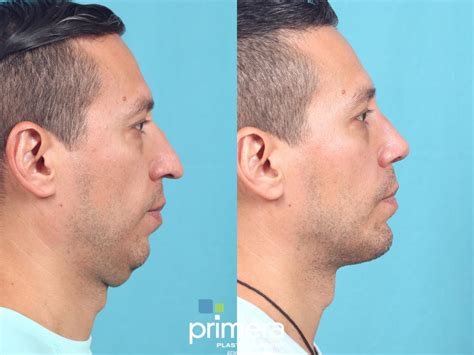 Submentoplasty Chin Tuck Before And After Pictures Case 720 Orlando