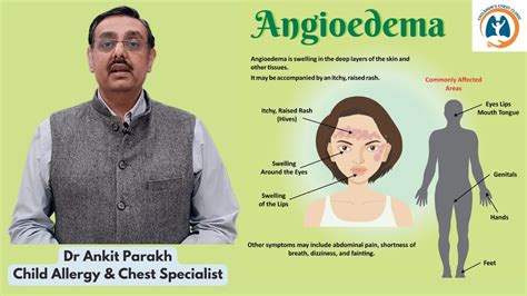 Angioedema In Children Symptoms Diagnosis And Treatment Dr Ankit