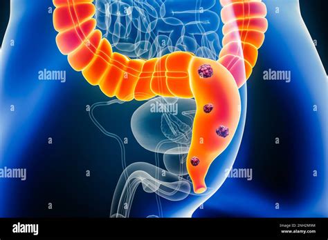 Colorectal Cancer Xray Hi Res Stock Photography And Images Alamy