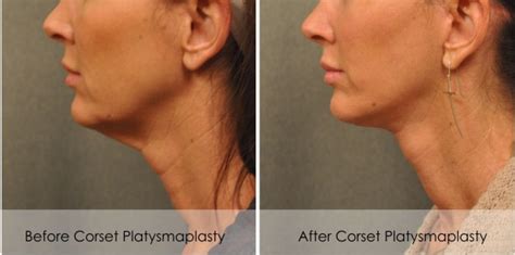 Cinching Up A Sagging Neck Is Easy With A Corset Platysmaplasty San