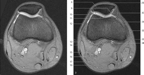 Knee Axial Ct Anatomy