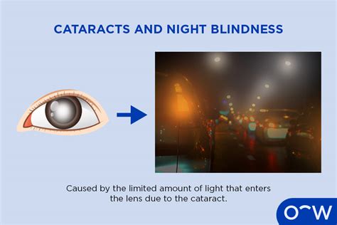 What Is Night Blindness Nyctalopia Causes Symptoms And Treatment