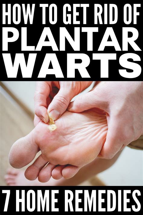 Home Remedies That Work 7 Natural Treatments For Plantar Warts In 2021
