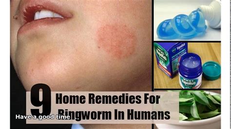 How Do You Treat Ringworm In Humans Youtube