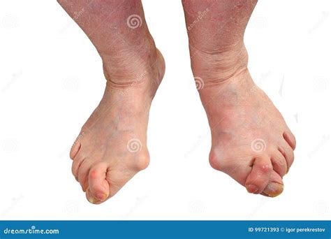 Medetcin Valgus Bunion Leg With Deformity Valgus Hallux Bunion