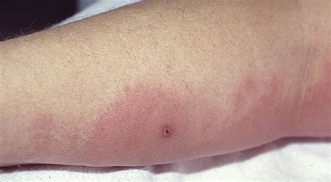 This area spreads to surrounding tissues, resulting in the typical signs. Cellulitis and Erysipelis - The Clinical Advisor