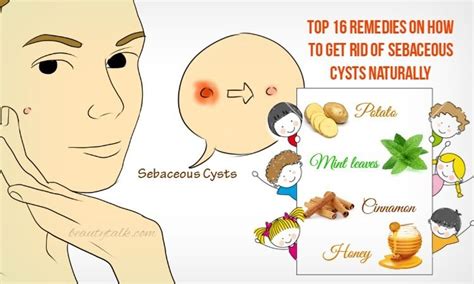15 remedies on how to get rid of sebaceous cysts naturally cysts beauty care beauty hacks