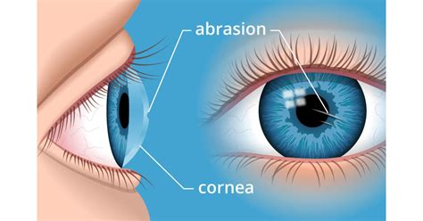 Corneal Abrasion How To Treat A Scratched Eye All About Vision