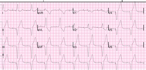 Dr Smiths Ecg Blog Neck And Jaw Pain In A Patient With A Pacemaker