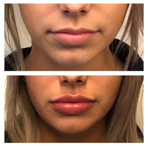 Lip Filler To Correct Asymmetry Boss Gal Beauty Bar
