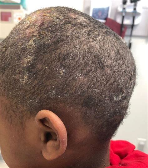 Clinical Challenge Scalp Lesions With Drainage And Lymphadenopathy