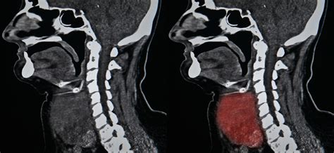 What Is A Ct Scan With Contrast Of The Neck