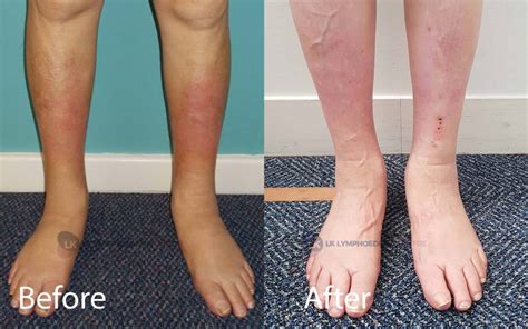 What Causes Chronic Swelling Lk Lymphoedema Centre