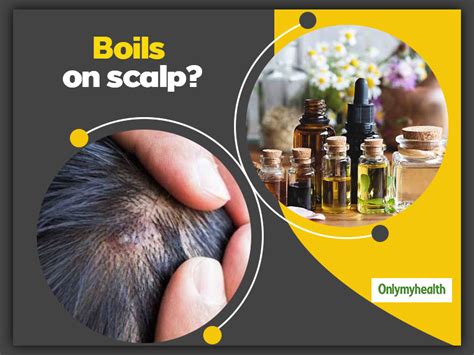 Boils On Scalp Here Are 5 Useful Home Remedies To Get Rid Of Them