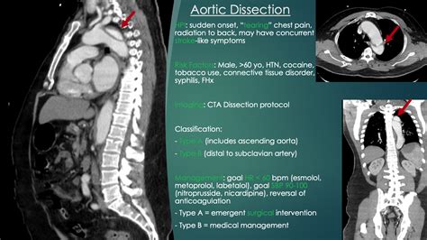 Aortic Dissection Diagnosis And Management Summary Grepmed
