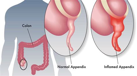 If an inflamed appendix is not removed, it is likely to rupture, leading to greater complications and pain. Is it appendicitis - or just a sore tummy? | Stuff.co.nz