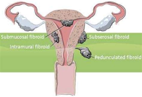 Uterine Fibroid Embolisation Or Uterine Artery Embolisation Uae