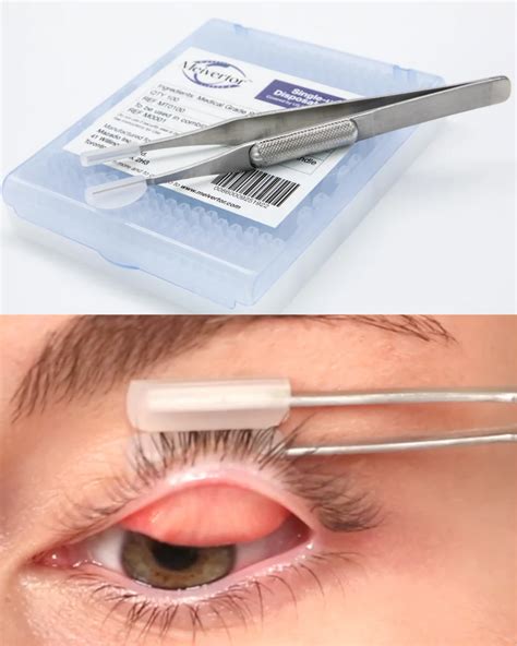 Single Hand Eyelid Eversion Tool For Mg Assessment