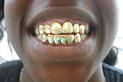 Though gold teeth help reduce wear on adjacent teeth and. Custom mouth grillz | XXX Porn Library