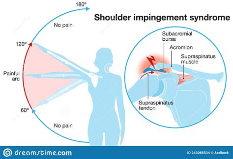Shoulder Impingement Sydrome Painful Arc Labeled Illustration Stock
