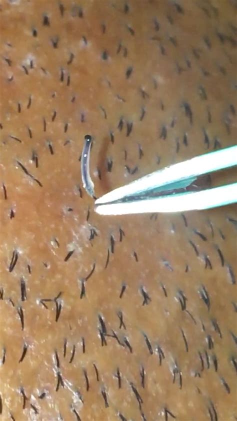Clogged Hair Follicle Pulled Out Floretta Large