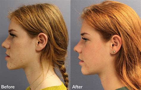 Maxillary Surgery Before And After