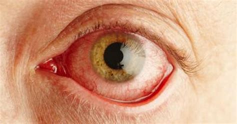 Causes Of Eye Discoloring Livestrongcom