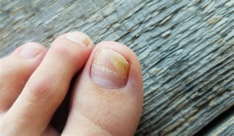 Fungal Nail Infection Waverley Foot Clinic
