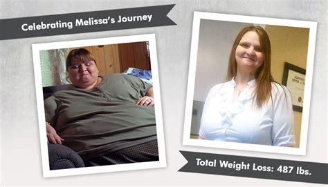 Before And After Rny With Melissa Of My 600lb Life Obesityhelp