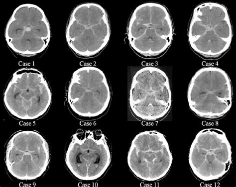 Initial Head Ct Scans Of 12 Patients Shows Diffuse Subarachnoid