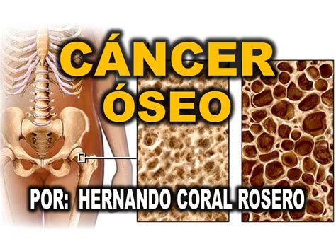 Cancer Oseo Cancer En Los Huesos Youtube