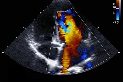 Echocardiogram What You Need To Know Upmc Healthbeat