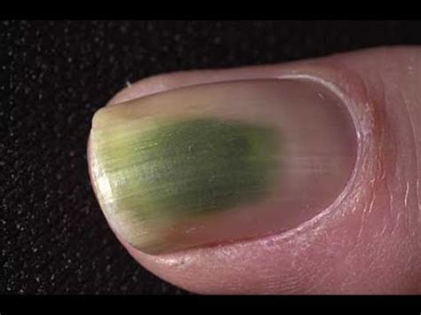 This is official l2 interlude retail x1 drop data of mob green fungus, if you think you've found a mistake please get in touch with us. Green Under Fingernail or Toenail: *SECRETS shared by a ...