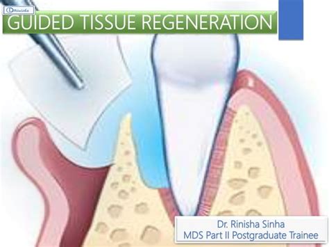 Guided Tissue Regeneration Ppt