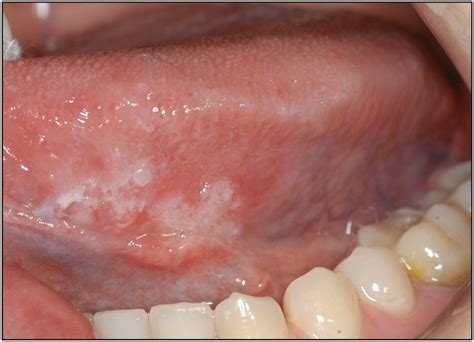 Tongue Squamous Cell Carcinoma In Babe Nonsmoking And Nondrinking Patients Clinical Cases Of
