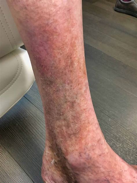 Loteria Bicamada Sentido Horário Skin Discoloration On Legs Pá Excesso