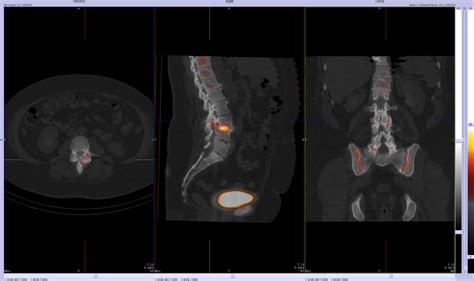 Bone Scan Spine Dr Iain Duncan