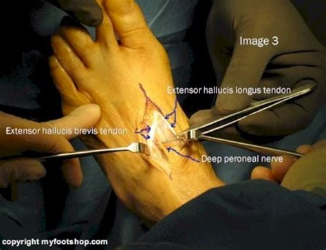 Tarsal Tunnel Syndrome As Related To Common Peroneal Nerve Dysfunction